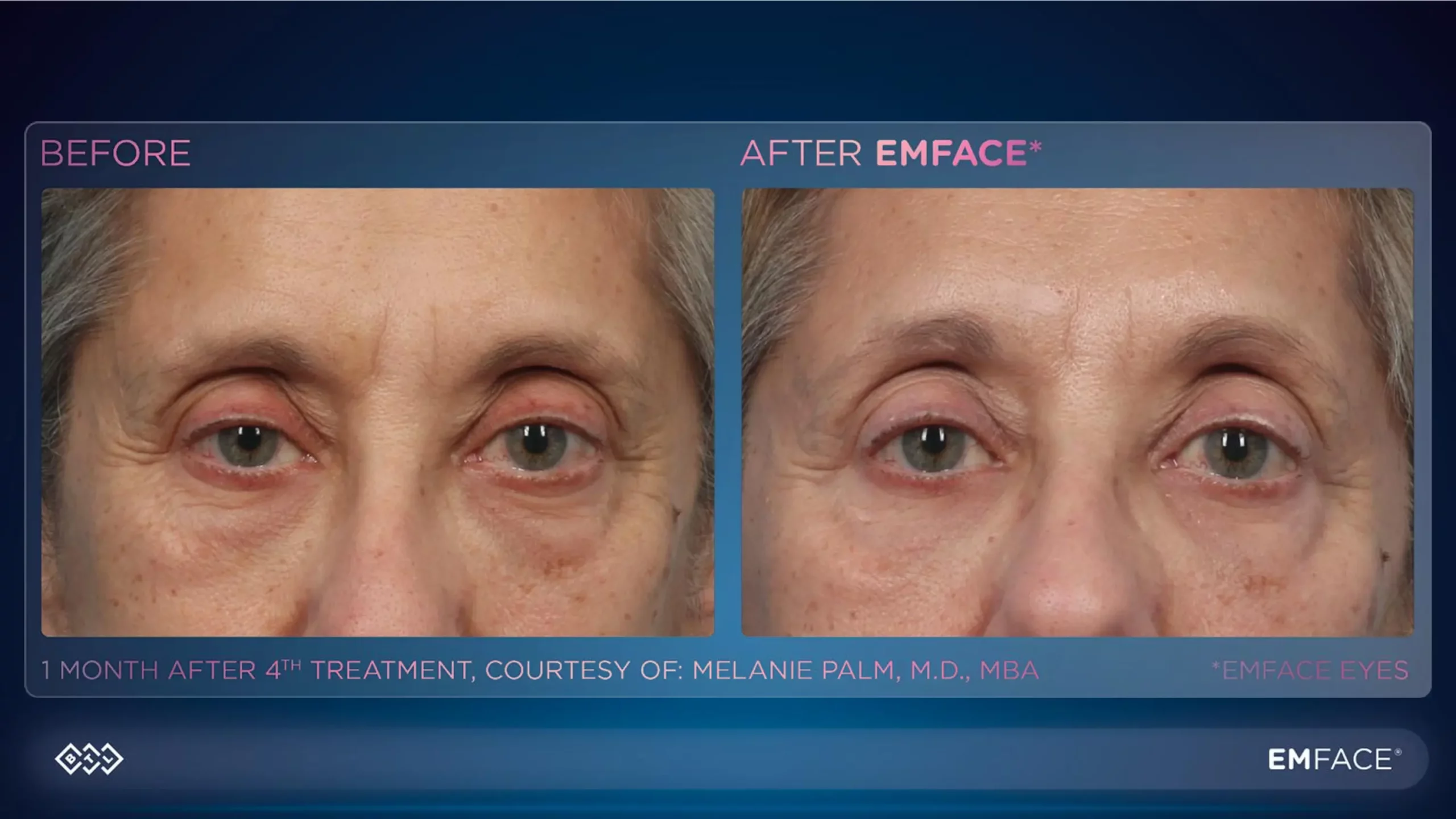 Under Eye Treatment Emface (2)