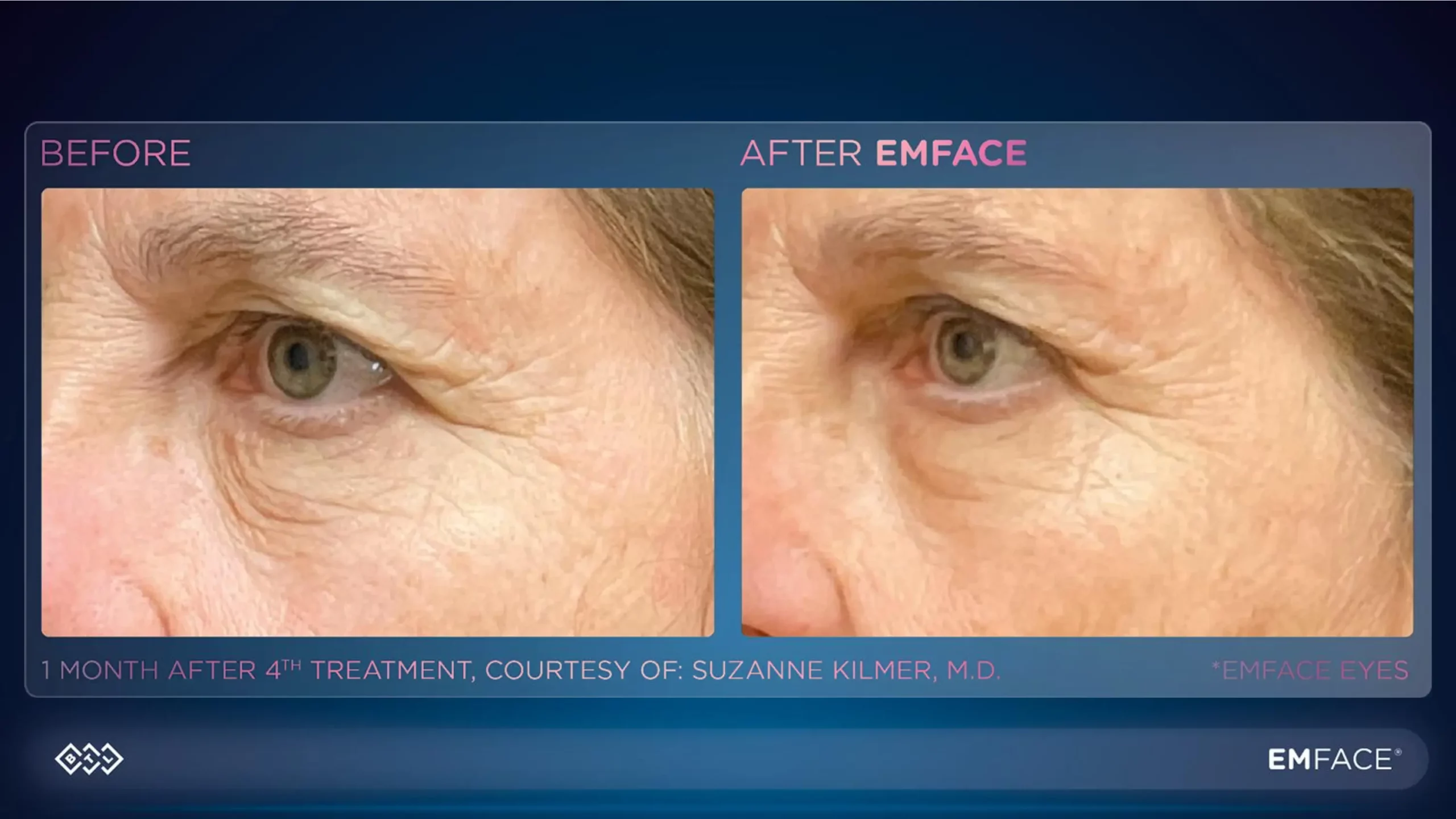 Under Eye Treatment Emface (3)