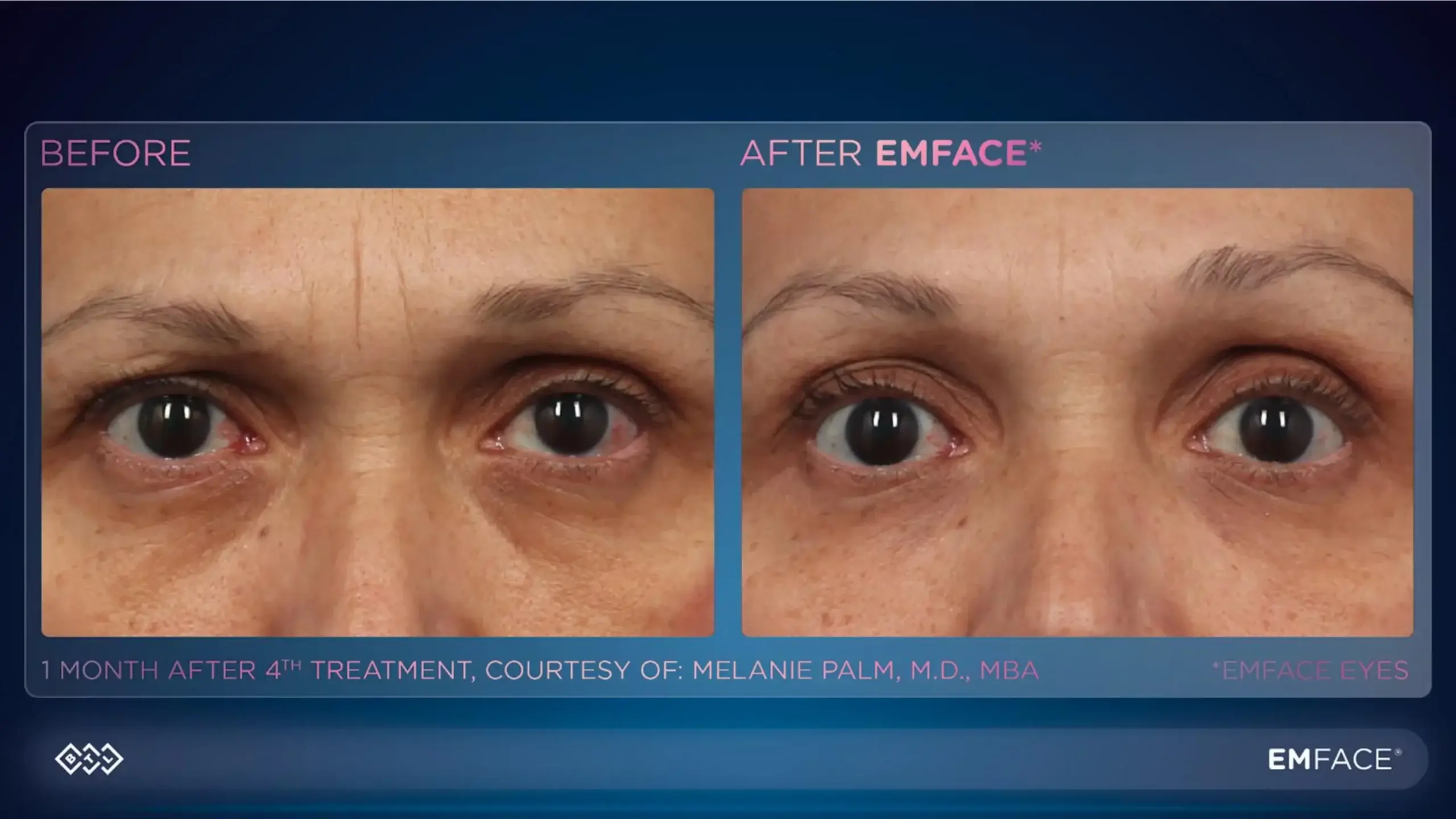 Emface treatment before and after images highlighting diminished under-eye wrinkles and smoother skin.