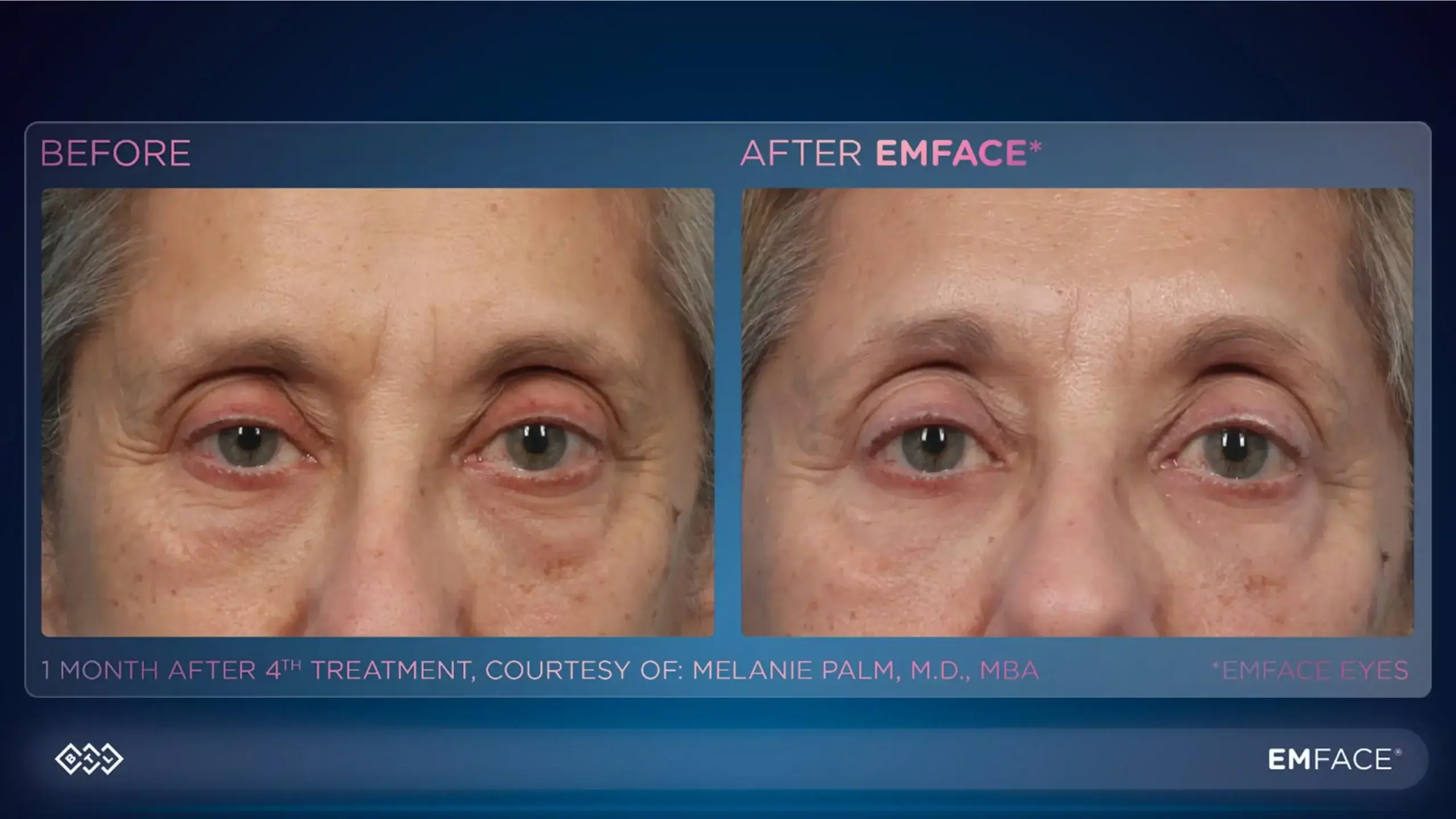 Before and after Emface treatment showing reduced under-eye wrinkles and skin improvements.