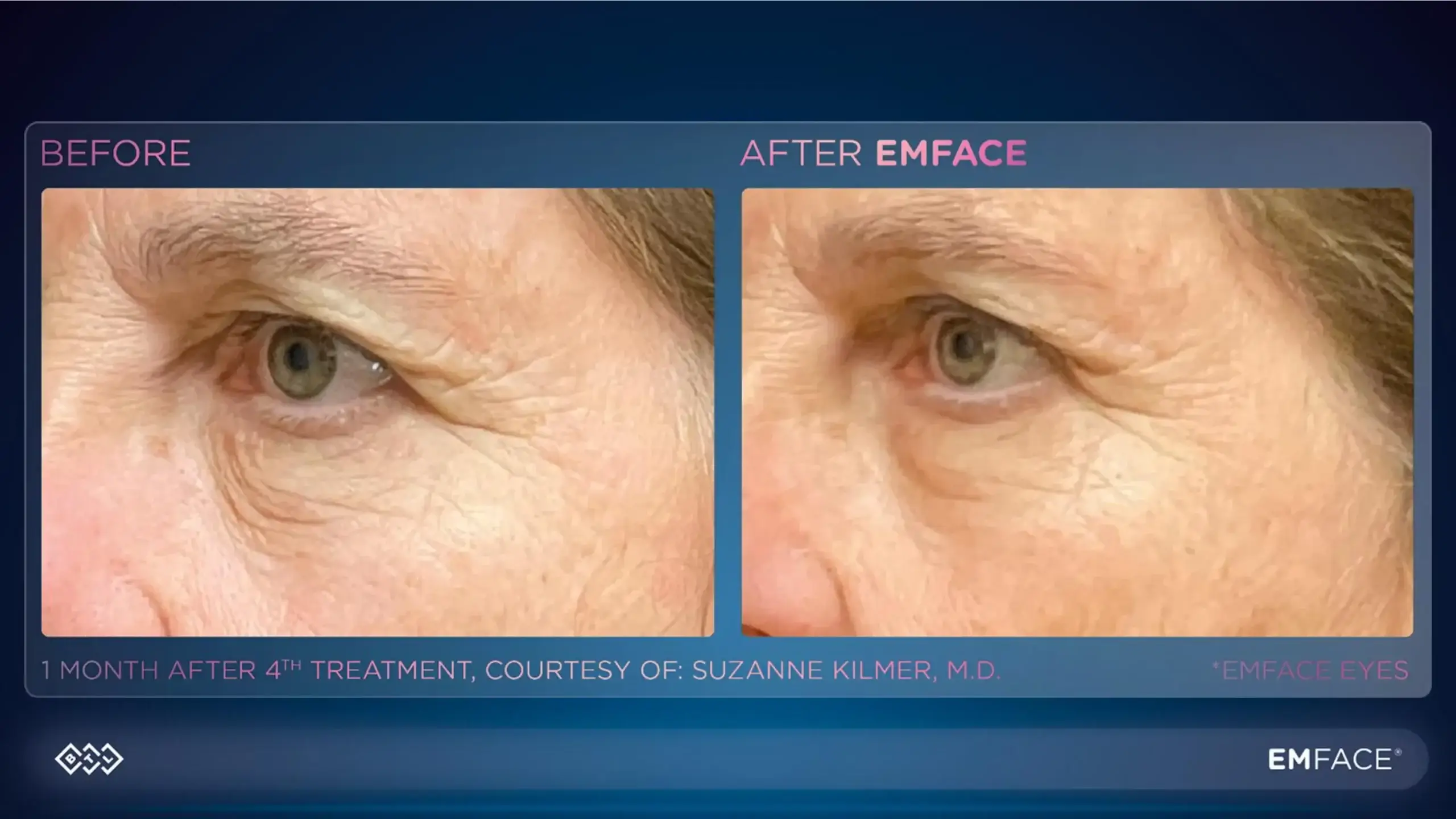 Before and after Emface treatment showing reduced wrinkles and improved skin texture under the eyes.