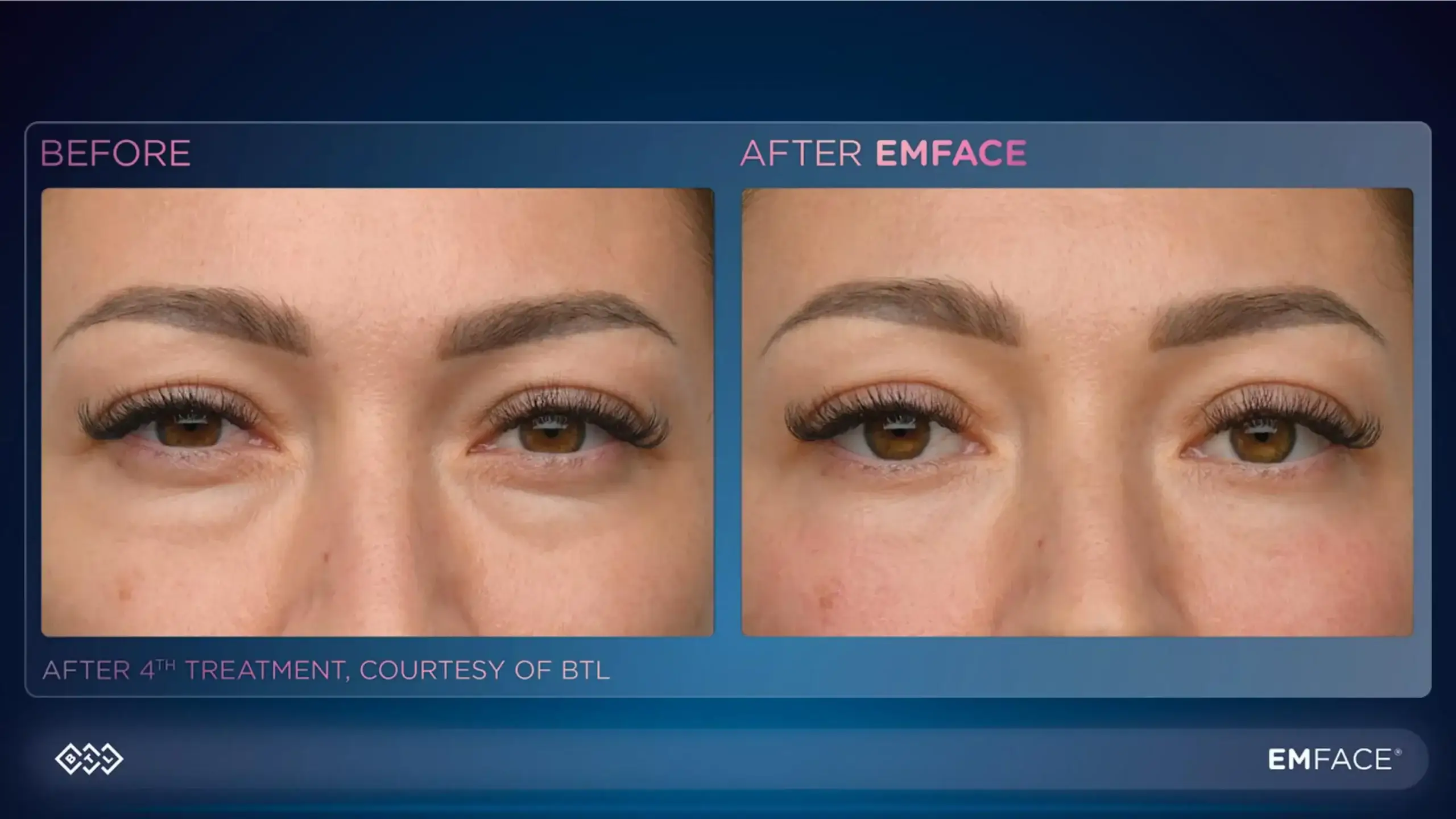 Before and after under eye treatment showing reduced puffiness, wrinkles, and improved skin texture.
