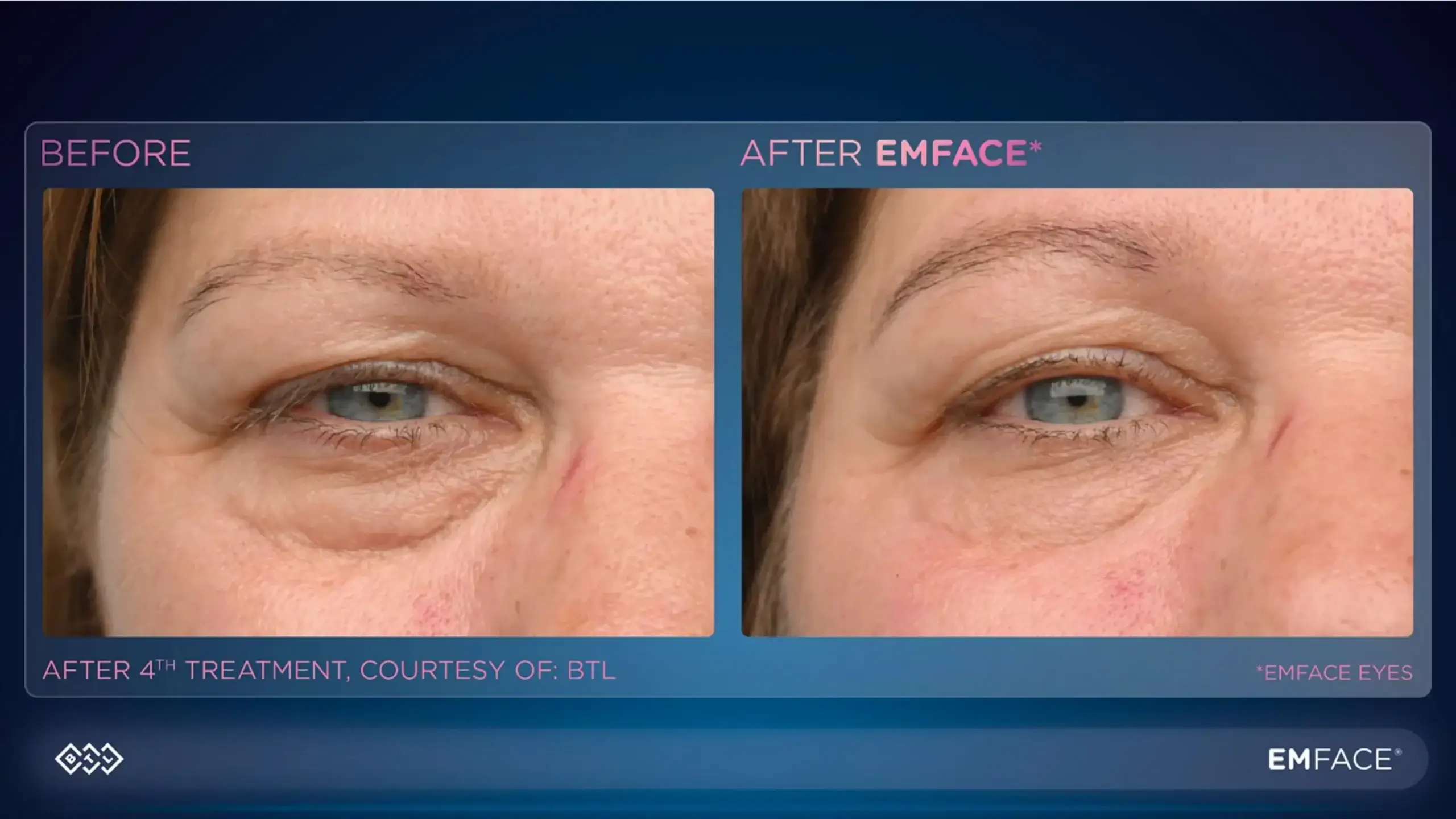 Before and after under eye treatment showing reduced puffiness, wrinkles, and skin improvement.