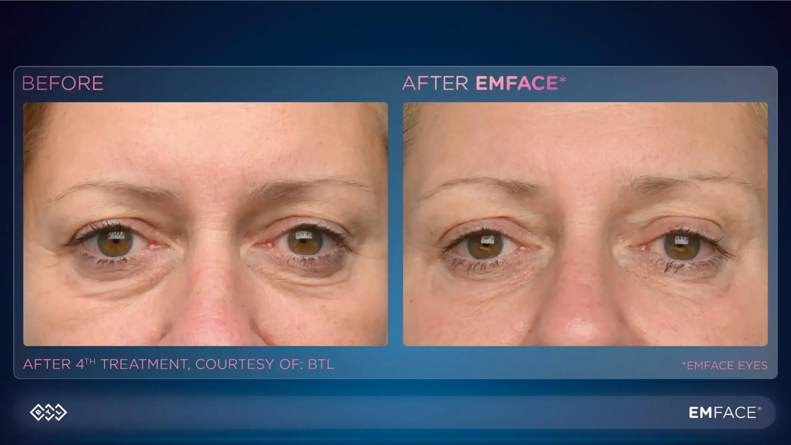 Before and after under eye treatment showing reduced puffiness and wrinkles.
